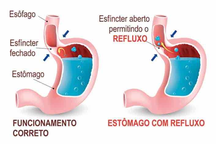 Imagem ilustrativa de procedimento de cirurgia do refluxo gastroesofagico