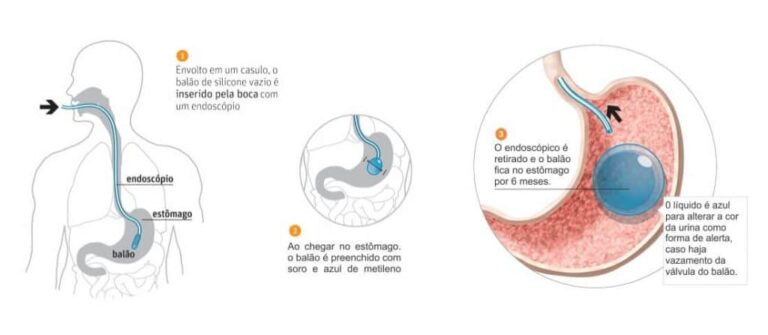 Imagem ilustrativa de endoscópio no estômago.