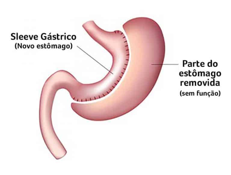 Imagem ilustrativa de gastrectomia vertical.