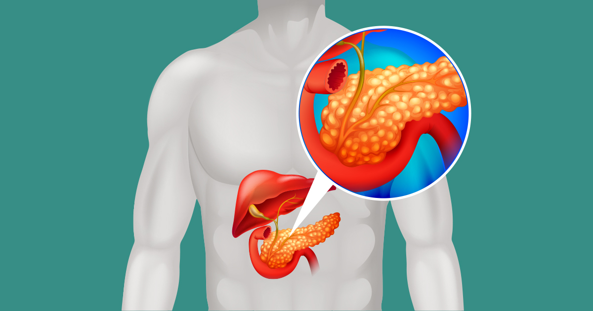 Pancreatite Aguda