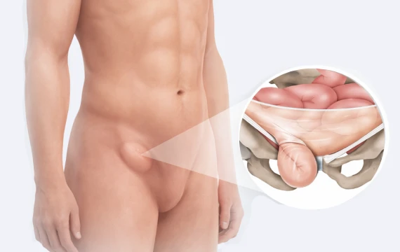 Hérnia inguinal