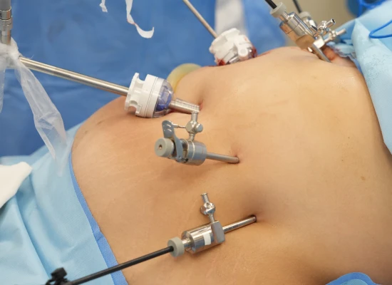 imagem Cirurgia bariátrica